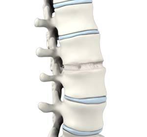 �Anterior Lumbar Interbody Fusion