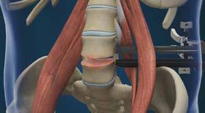 Lumbar Endoscopic Discectomy