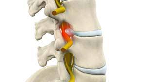 Lumbar Radiculopathy