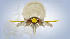 Spinal Stenosis