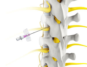 Spinal Injections